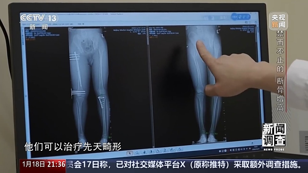 新闻调查丨术后麻MK体育烦不断 禁而不止的“断骨增高” 有多坑？(图3)