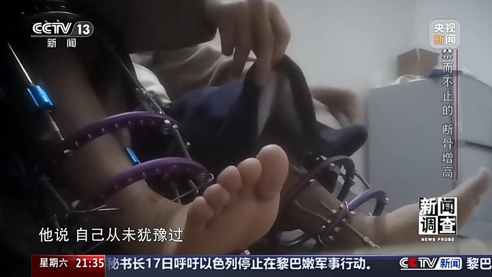 新闻调查丨术后麻MK体育烦不断 禁而不止的“断骨增高” 有多坑？(图2)
