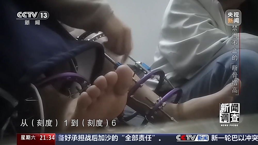 新闻调查丨术后麻MK体育烦不断 禁而不止的“断骨增高” 有多坑？(图1)