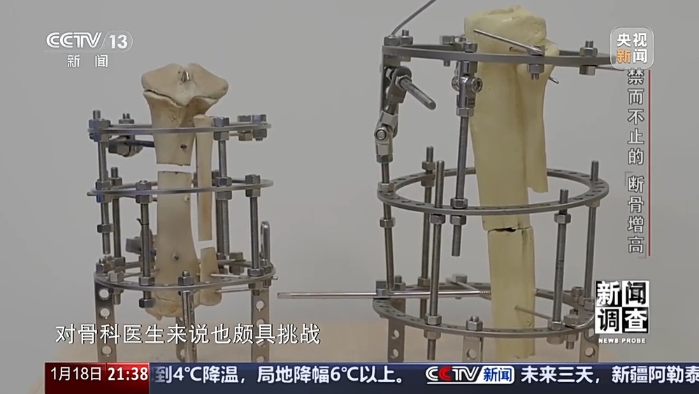 新闻调查丨术后麻MK体育烦不断 禁而不止的“断骨增高” 有多坑？(图6)