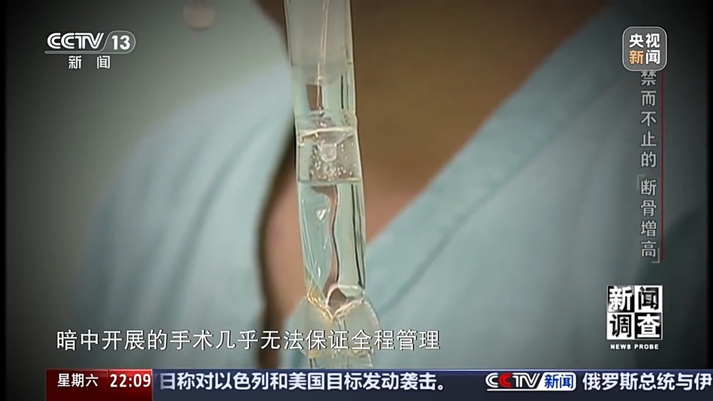 新闻调查丨术后麻MK体育烦不断 禁而不止的“断骨增高” 有多坑？(图24)