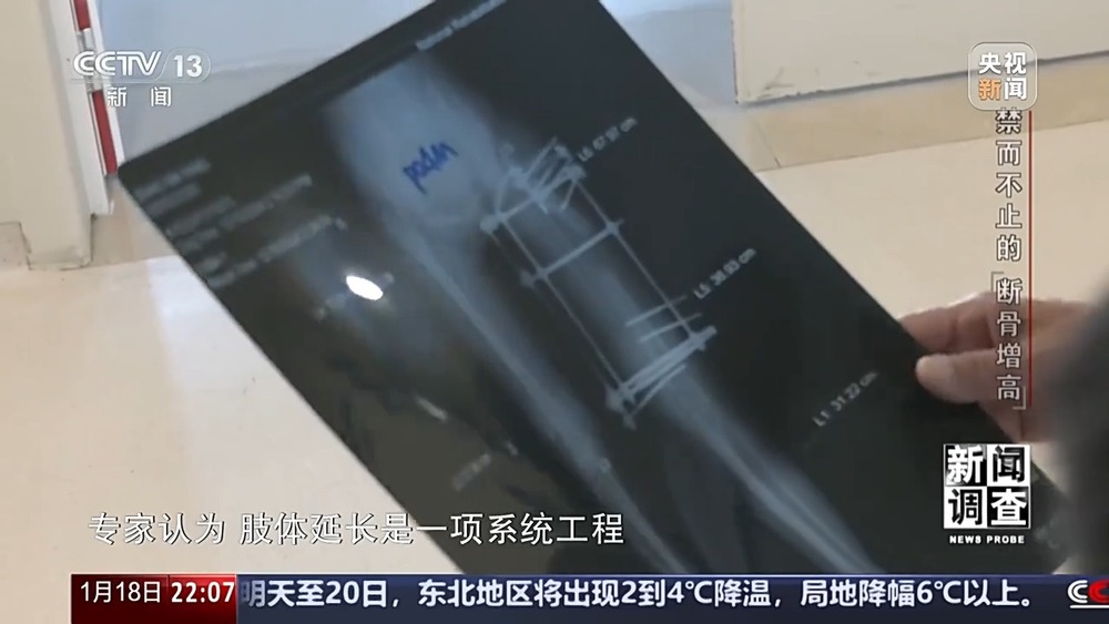 新闻调查丨术后麻MK体育烦不断 禁而不止的“断骨增高” 有多坑？(图22)
