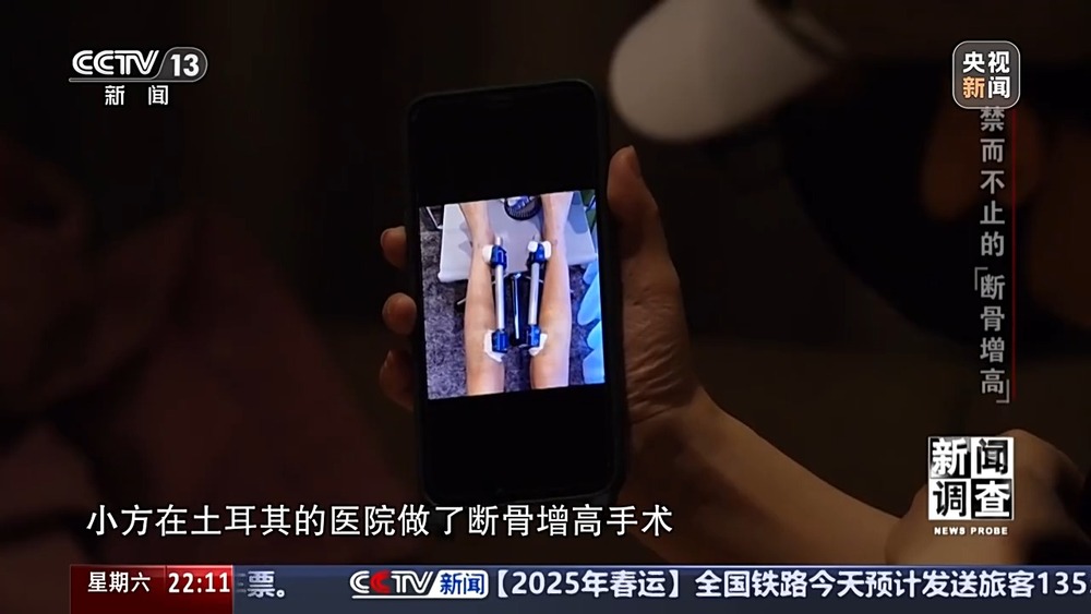 新闻调查丨术后麻MK体育烦不断 禁而不止的“断骨增高” 有多坑？(图25)