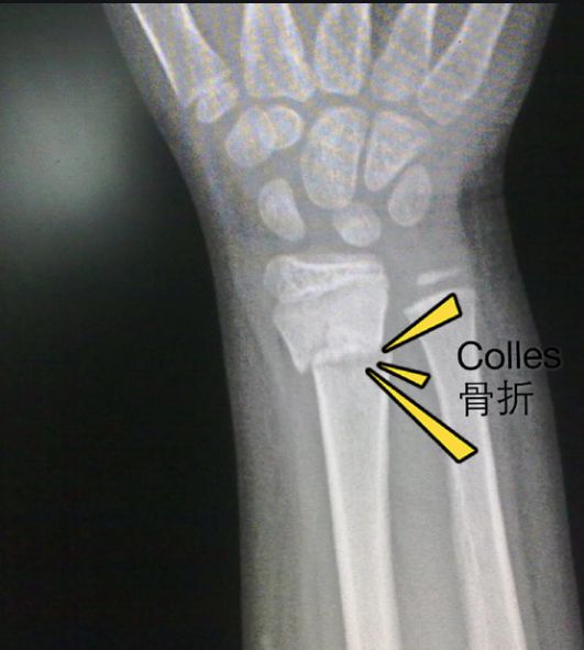 MK体育骨折患者肿胀缓解新选择：探索ACC钙的康复效果(图1)