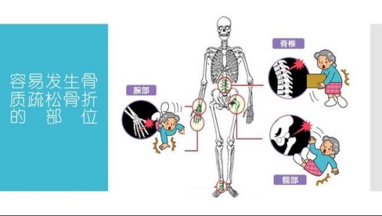 MK体育骨折患者肿胀缓解新选择：探索ACC钙的康复效果(图2)