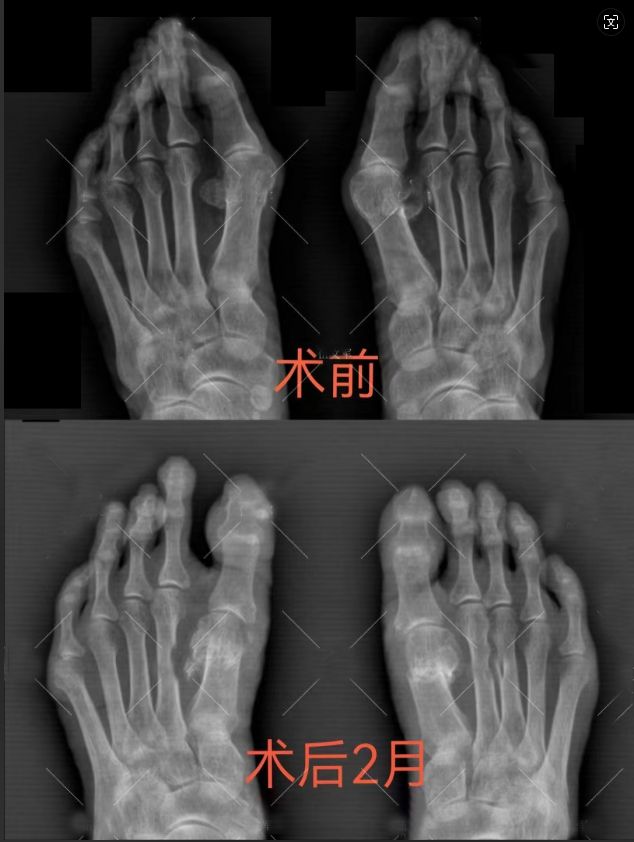 MK体育长沙年轮一位踇外翻患者的康复之路
