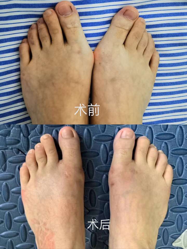 MK体育长沙年轮一位踇外翻患者的康复之路(图2)
